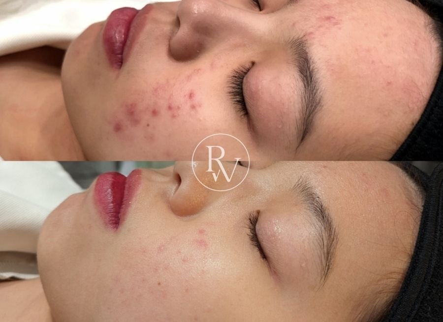 Acne tx before and after