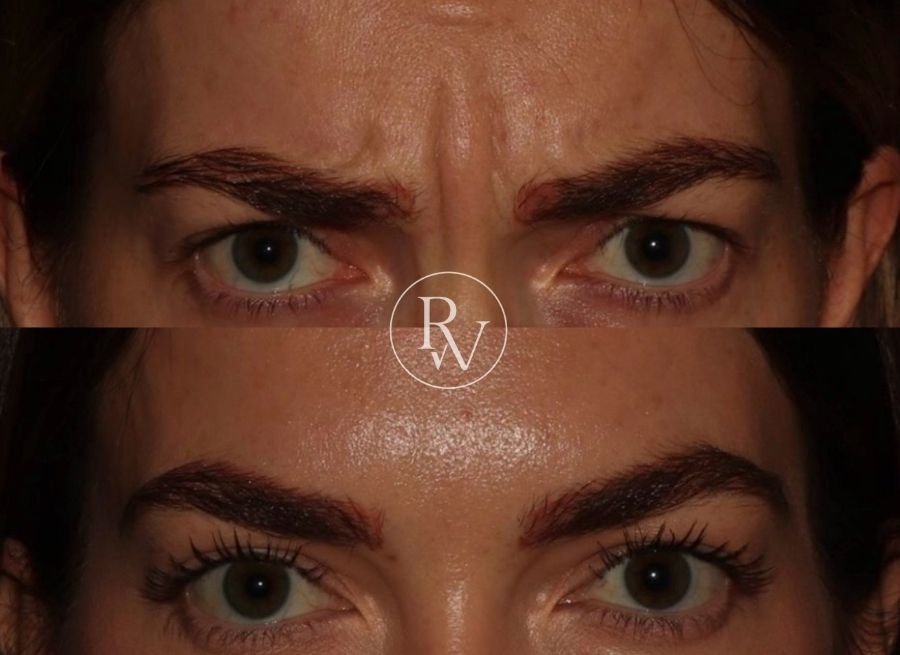 Botox frown before and after