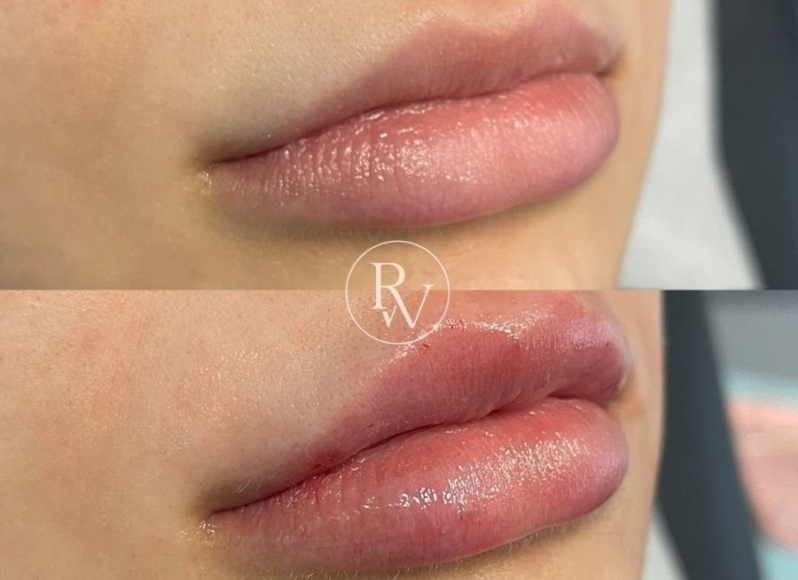 lip fillers before and after