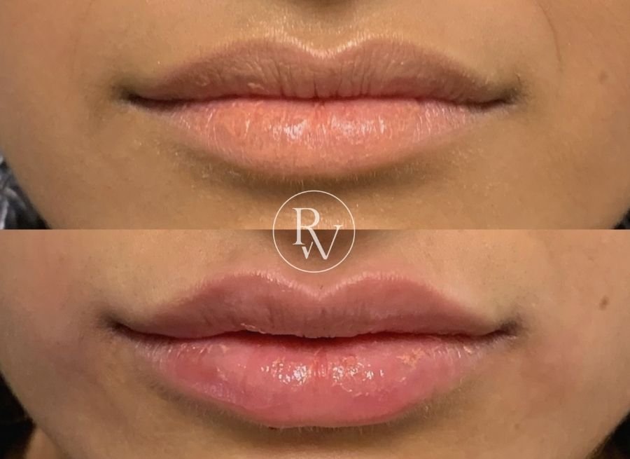 lip fillers before and after