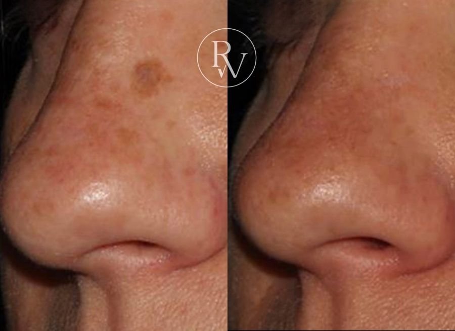 Mole removal before and after