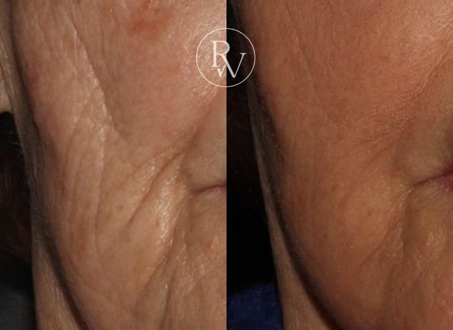 skin boosters before and after
