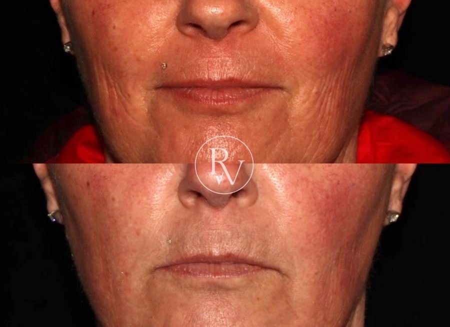 skin boosters before and after