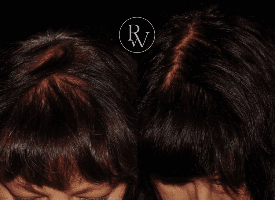prp hair treatment
